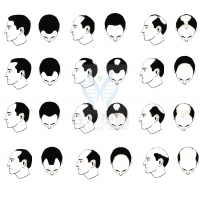 【royal皇家88基因检测】过早<font color='red'>脱发</font>、掉发太多怎么办？你的方法可能是错的！